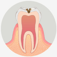 虫歯が神経に近くなり、冷たいものがしみます
