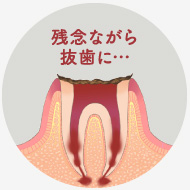 神経が死んでしまい、痛みを感じなくなります